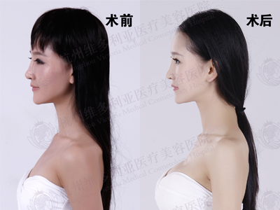 隆胸前后对比图 隆胸前后对比图