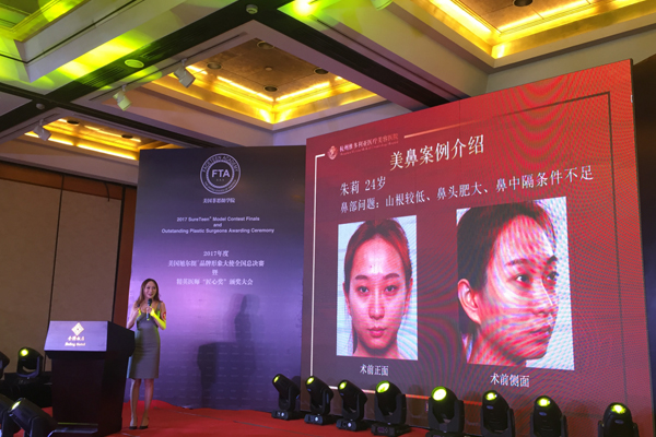 杭州维多利亚旭尔挺隆鼻真人案例